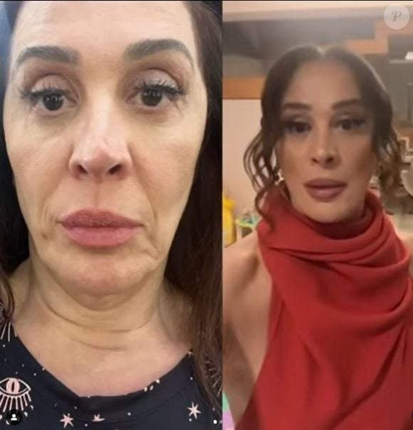 Claudia Raia mostrou o antes e depois de seu rosto após os procedimentos estéticos